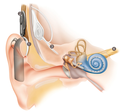 how does a cochlear implant work