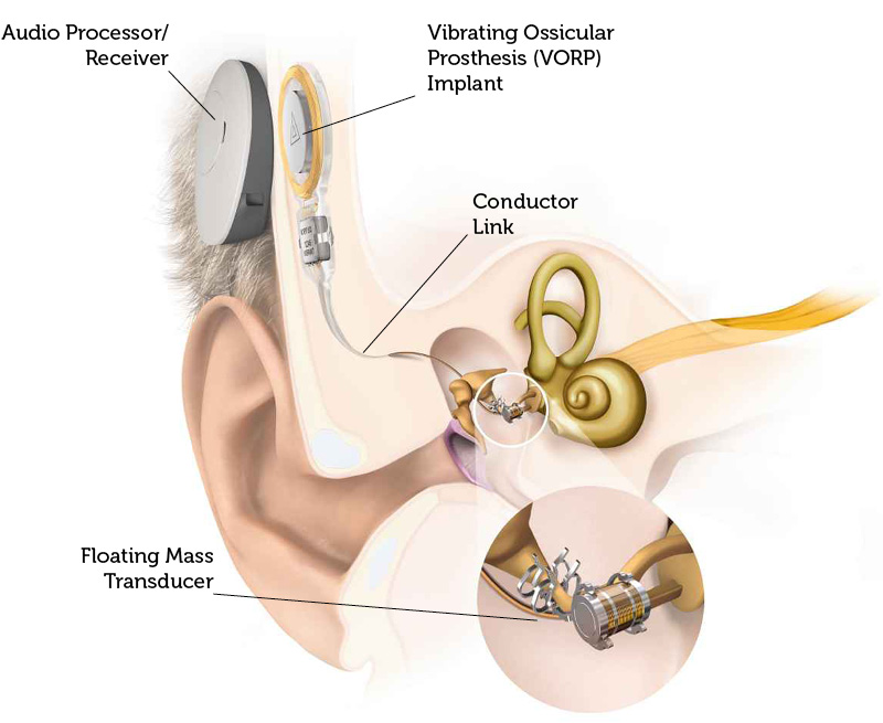middle ear implant vorp diagram